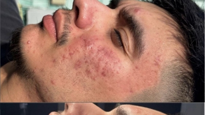 Salicylic Acid Peel Photo