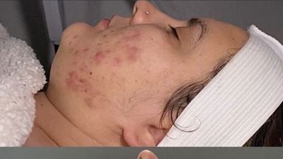 Salicylic Acid Peel Photo