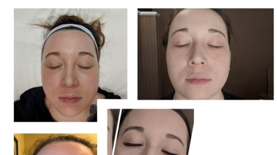 Derma Peel Photo