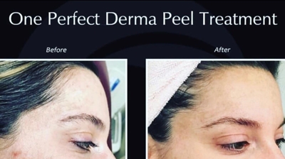 Derma Peel Photo