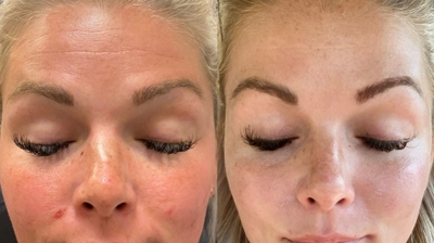 Derma Peel Photo