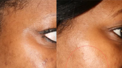 Derma Peel Photo