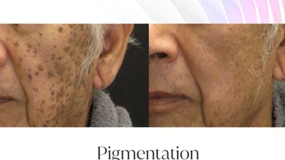 IPL Before and After Photo