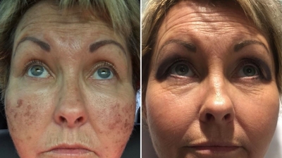 IPL Before and After Photo