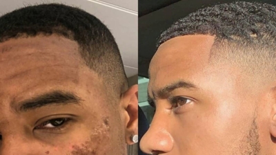 IPL Before and After Photo