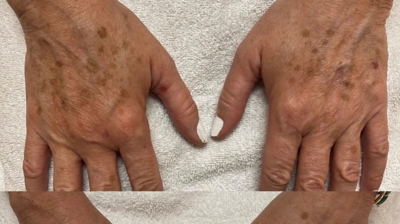 IPL Before and After Photo