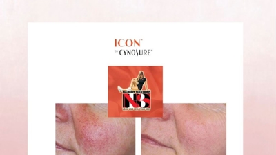 IPL Before and After Photo