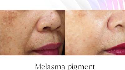 IPL Before and After Photo