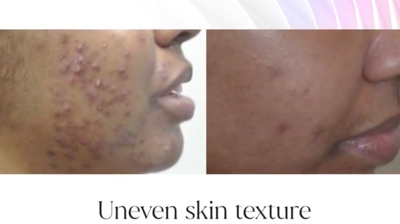 IPL Before and After Photo