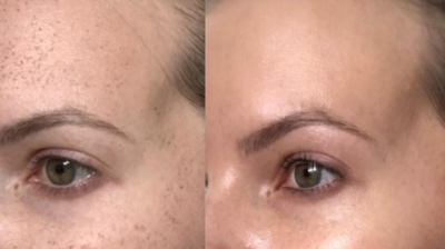 IPL Before and After Photo