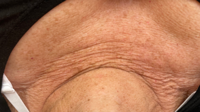 IPL Before and After Photo