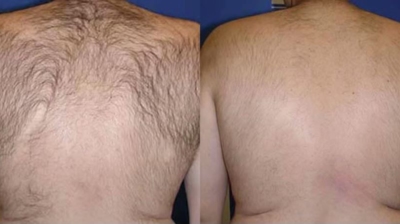 Laser Hair Removal Photo