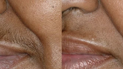 Laser Hair Removal Photo