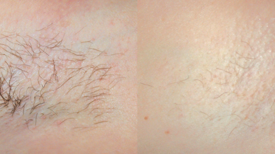 Laser Hair Removal Photo