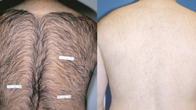 Laser Hair Removal Photo
