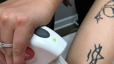 Laser Hair Removal Photo