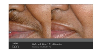 Laser Hair Removal Photo