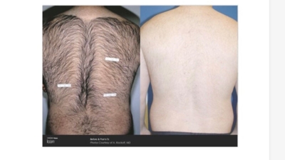 Laser Hair Removal Photo