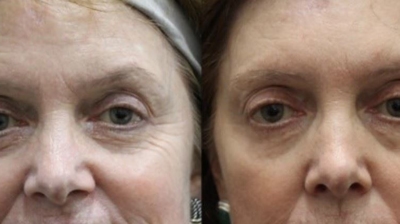 Laser Skin Resurfacing Photo