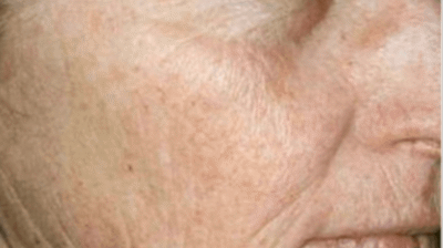 Laser Skin Resurfacing Photo