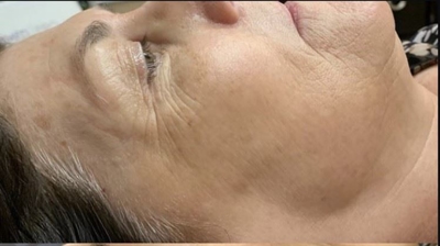 Microneedling Photo
