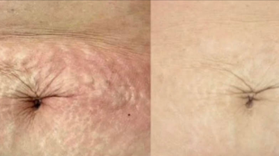 Microneedling Photo