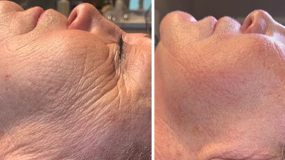 Microneedling Photo