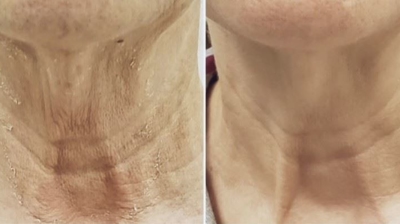 RF Microneedling Photo