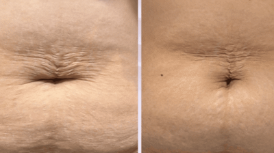 RF Microneedling Photo