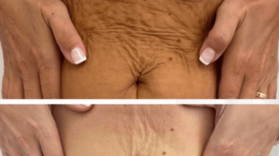 RF Microneedling Photo