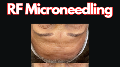 RF Microneedling Photo
