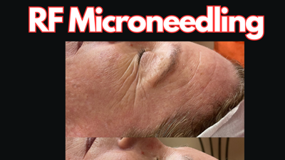 RF Microneedling Photo