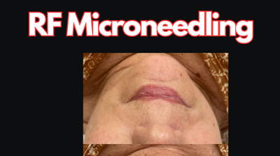 RF Microneedling Photo
