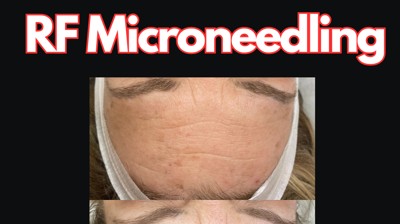 RF Microneedling Photo