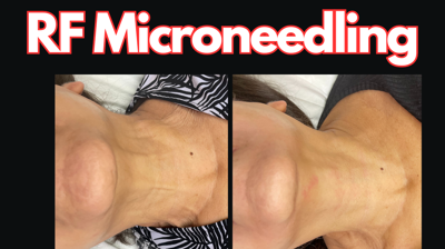 RF Microneedling Photo