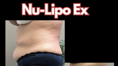 NuLipo Ex Advanced Photo