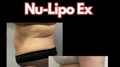 NuLipo Ex Advanced Photo