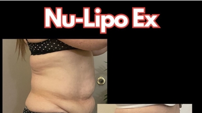 NuLipo Ex Advanced Photo