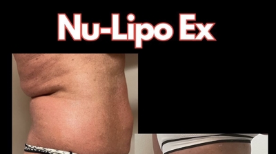 NuLipo Ex Advanced Photo