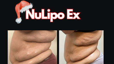 NuLipo Ex Advanced Photo