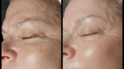 Microdermabrasion Photo