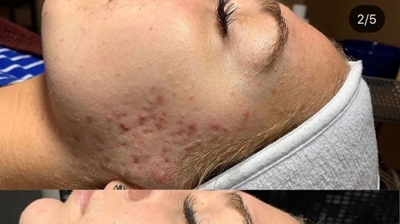 Microdermabrasion Photo