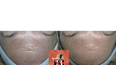 Microdermabrasion Photo