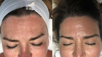 Rezenerate Facial Photo