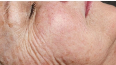 Rezenerate Facials Photo