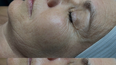 Rezenerate Facials Photo