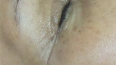 Rezenerate Facial Photo