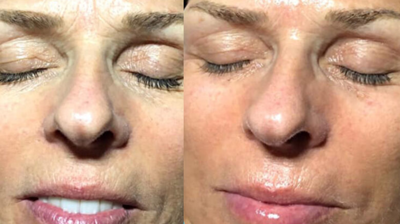 Rezenerate Facial Photo