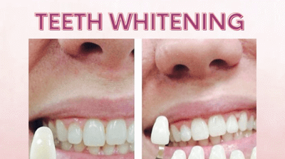 Teeth Whitening Photo