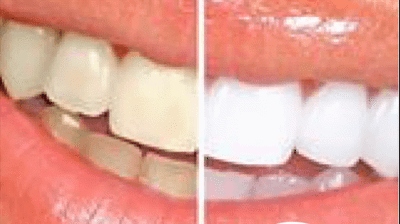 Teeth Whitening Photo